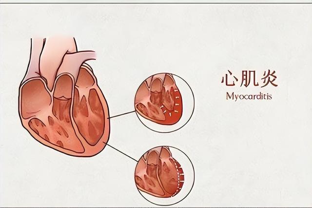 心肌炎的癥狀有哪些？心肌炎的主要變現(xiàn)癥狀有啥？